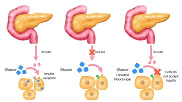 diabetul-insulina